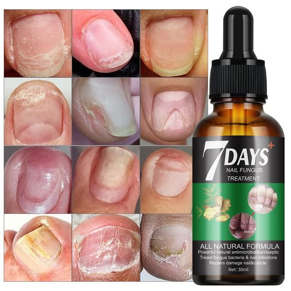 New Arrival 7 Days Nail Fungus Treatment Serum Treast Fungus Bacteria Repair Damage Nail 30ml MOOYAM Nail Treatment Serum